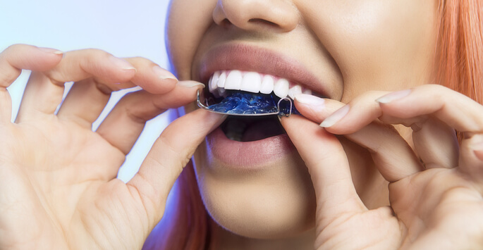 Kinds of Retainers