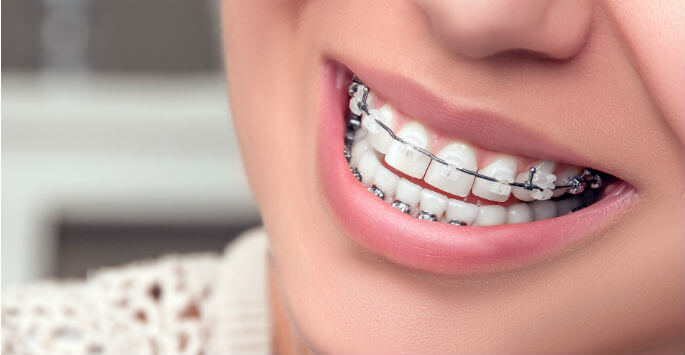 adult orthodontics