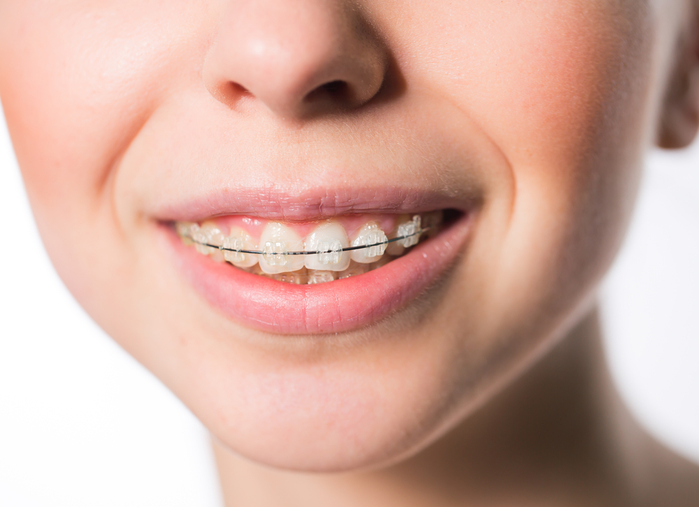 overbite treatment