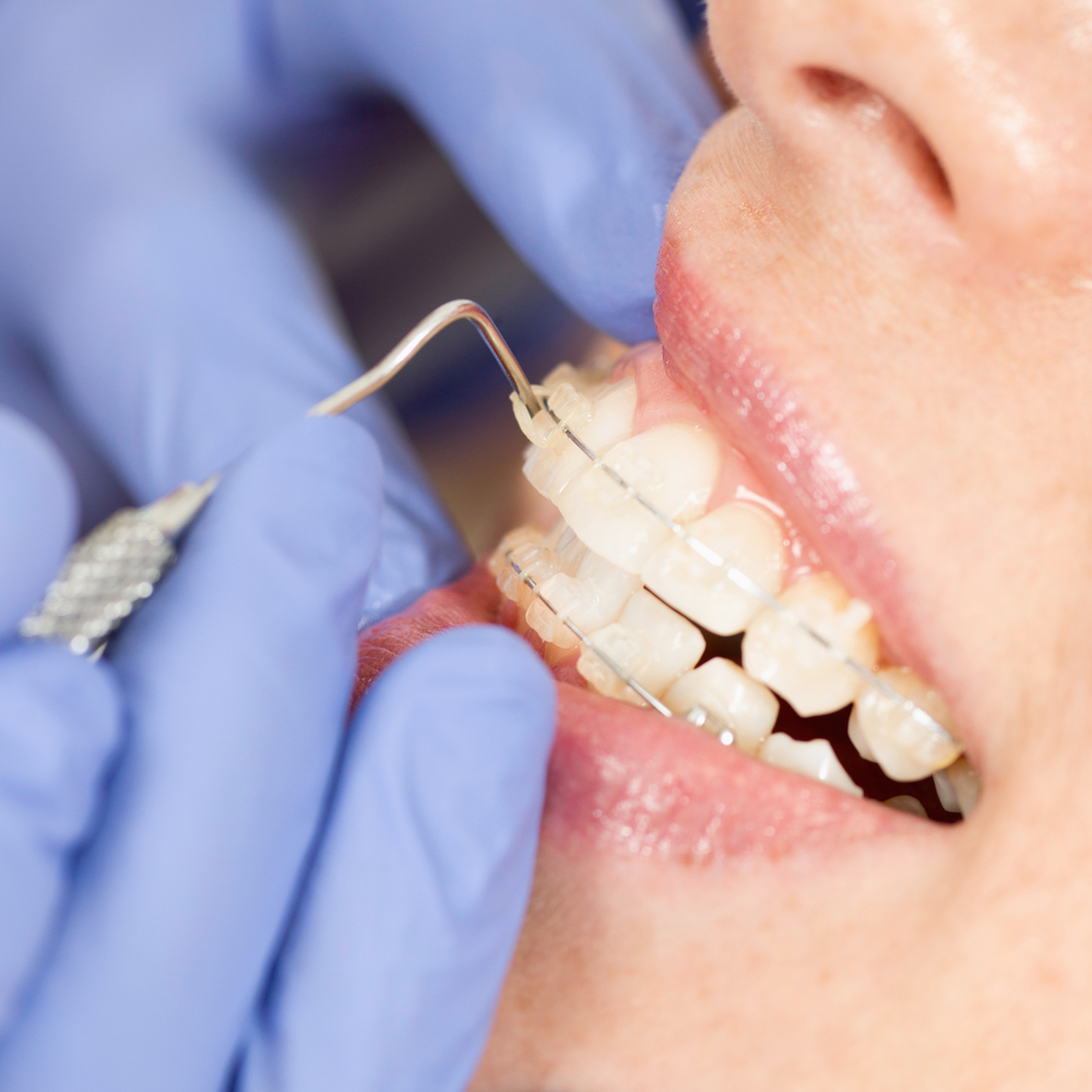 ceramic braces