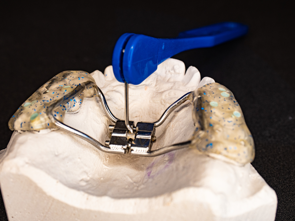 palate expander