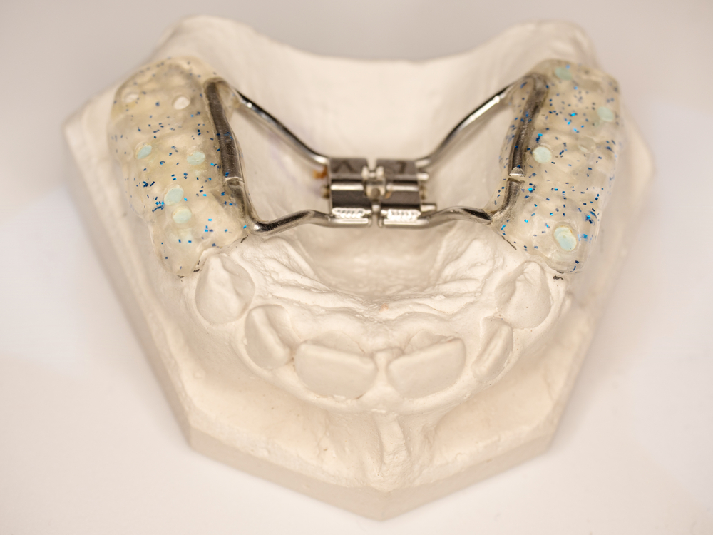 PALATE EXPANDER